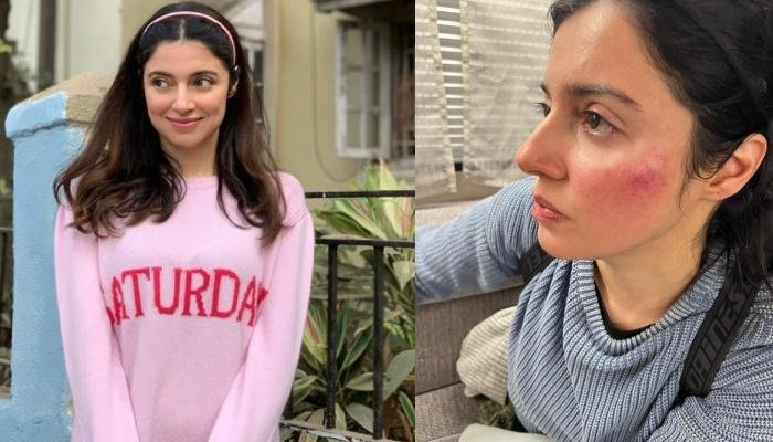 Divya Khosla Kumar Trolled For Sharing Injury Pictures, Netizens React ‘Apne Babu Se Foo Karwa Lo’